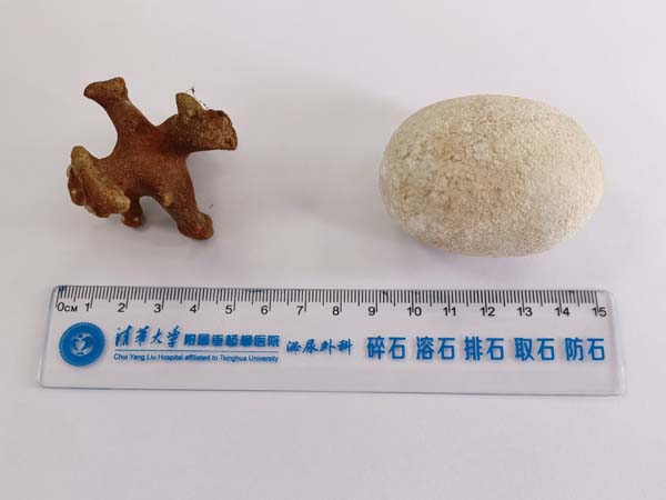 左为杨先生分叉结石,右常见结石.jpg 左为杨先生分叉结石,右常见结石.jpg