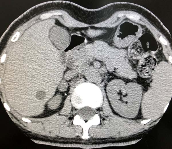 右肾上腺结节.jpg 右肾上腺结节.jpg