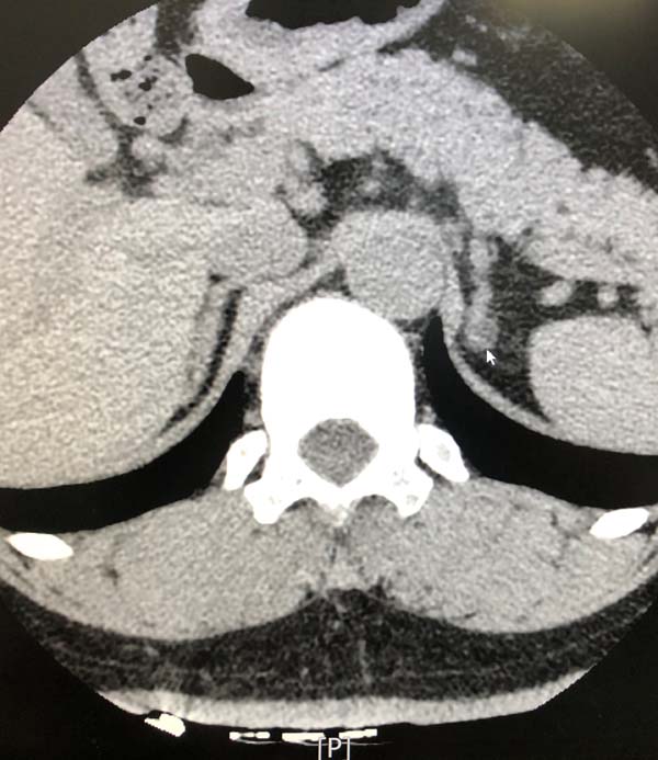 左肾上腺结节.jpg 左肾上腺结节.jpg