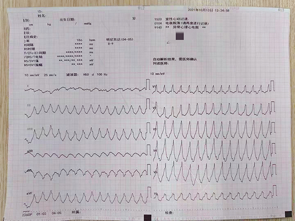 室性心动过速发作.jpg 室性心动过速发作.jpg