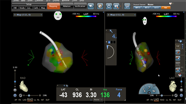 室速标测消融.jpg 室速标测消融.jpg