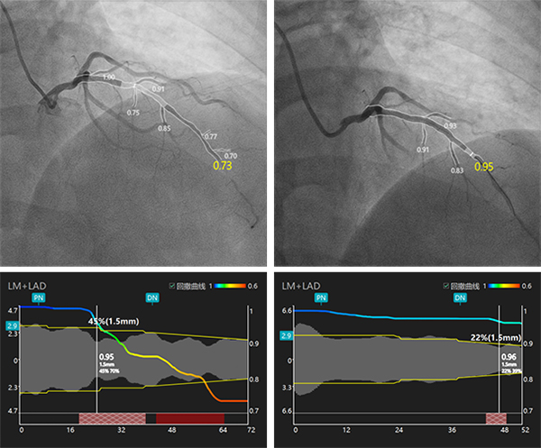 前降支治疗前1.jpg 前降支治疗前1.jpg