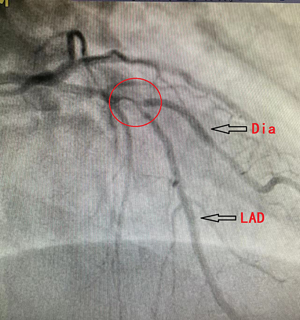 前降支近至中段50-90%弥漫狭窄,第二对角支开口70%局限性狭窄.jpg 前降支近至中段50-90%弥漫狭窄,第二对角支开口70%局限性狭窄.jpg