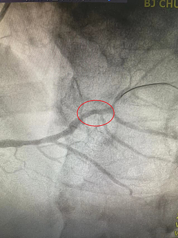 PCI术后.jpg PCI术后.jpg