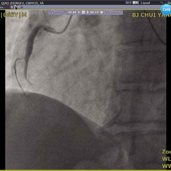 右冠脉堵塞.jpg 右冠脉堵塞.jpg