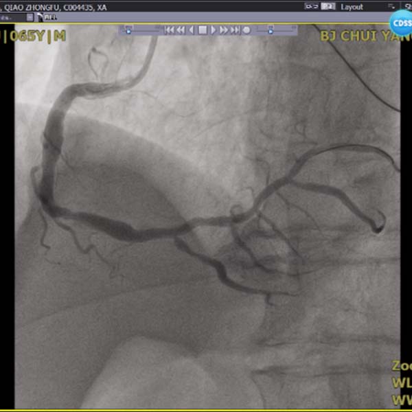 右冠脉再通.jpg 右冠脉再通.jpg